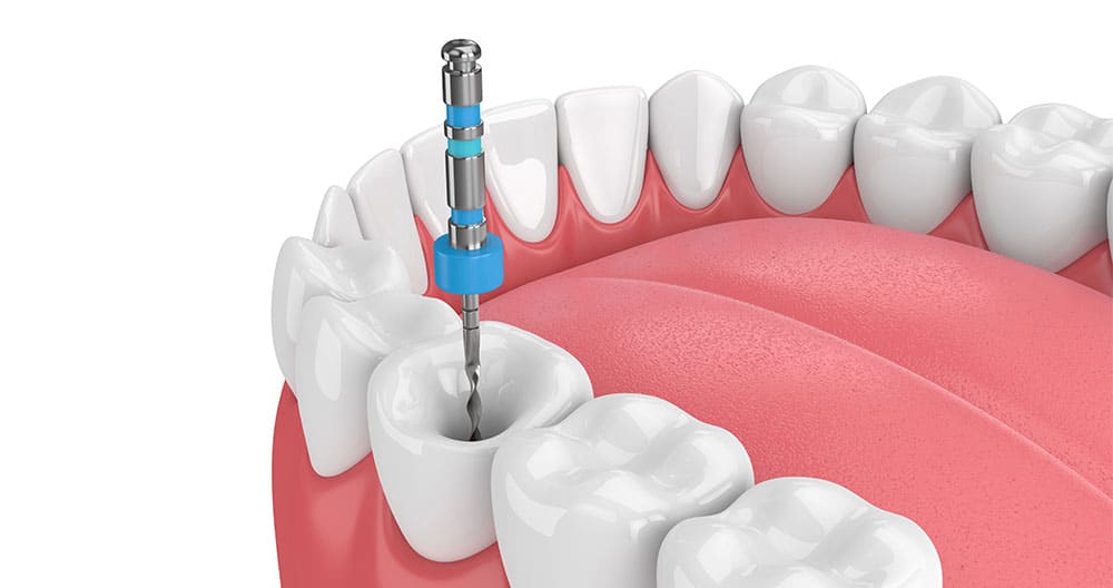 Illustration of a root canal instrument cleaning inside a molar